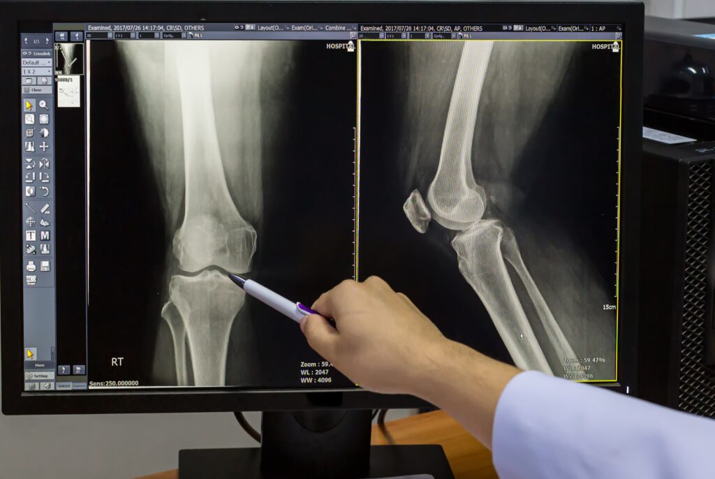 Rayos X de Rodilla