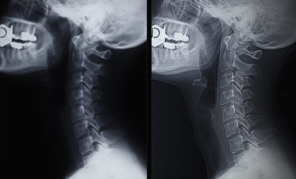 Rayos X Cervical